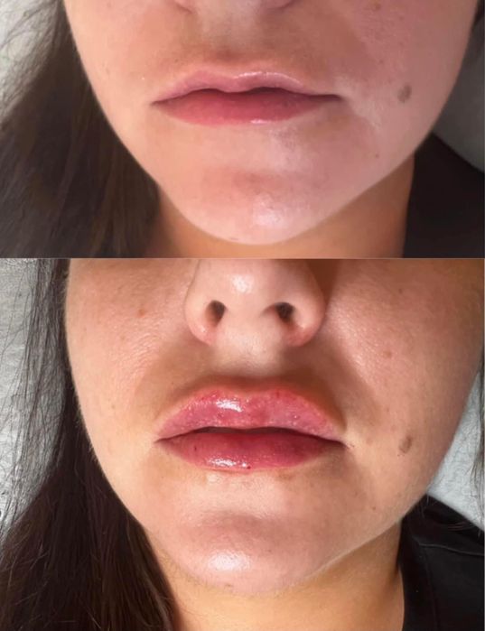 Super Promocja 450zł Modelowanie powiększanie ust wyrównanie asymetrii