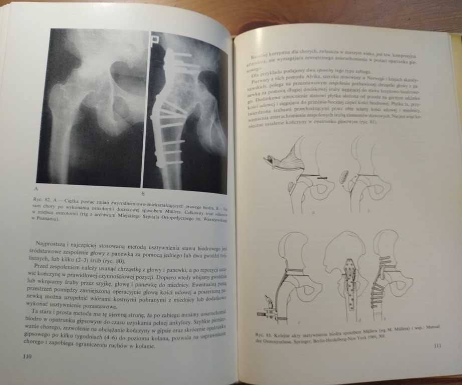 Ortopedia Garlicki Kreczko arthrosis deformans coxae