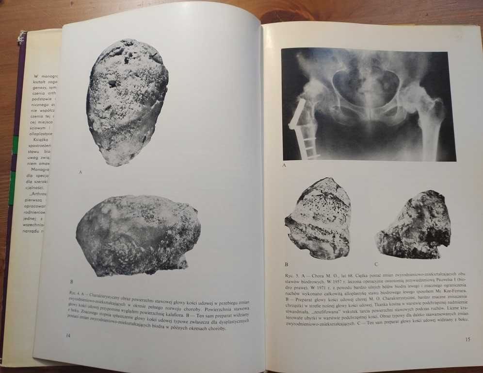Ortopedia Garlicki Kreczko arthrosis deformans coxae