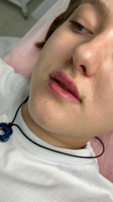 Збільшення губ / моделювання губ