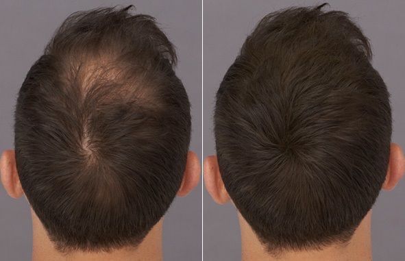 Трихолог, випадіння волосся, алопеція, пілінг шкіри голови, лупа