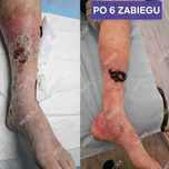 Pijawki, akupunktura, medycyna chińska, naturoterapia.
