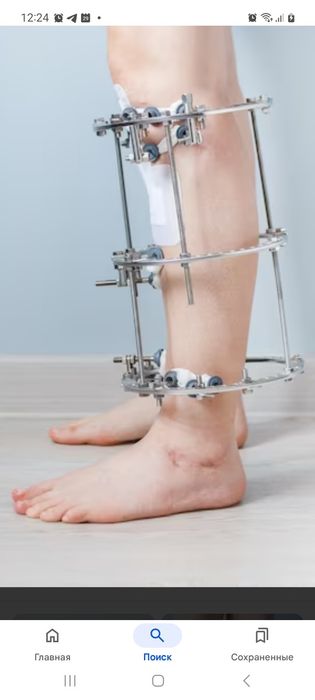 Апарат Iлiзарова