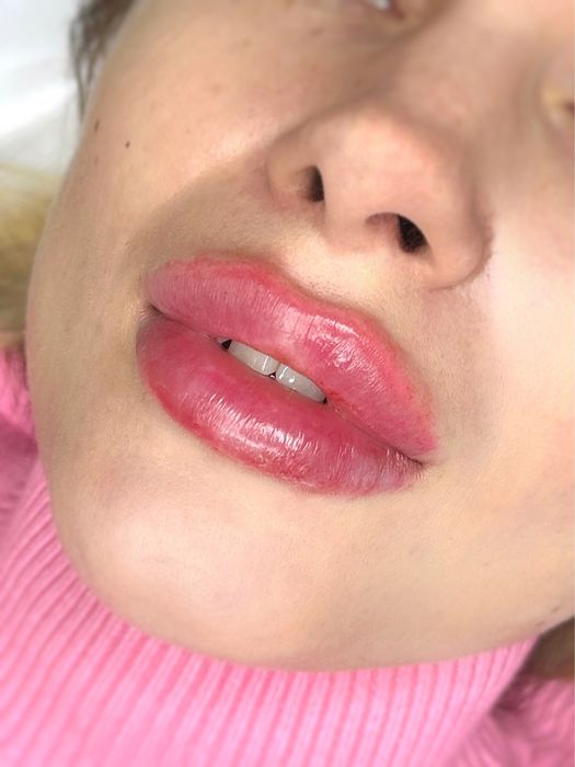 Губы от 2000грн, косметолог, ботокс,мезо-,био-, ТРК УКРАИНА