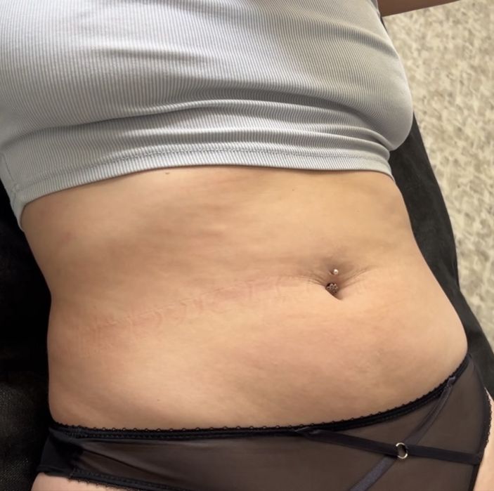 Антицелюлітний масаж