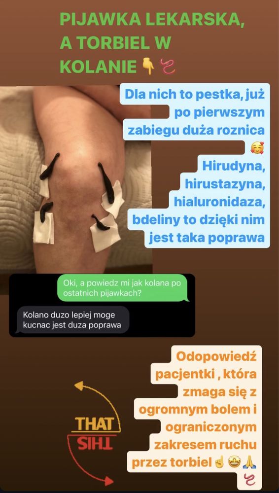 HIRUDOTERAPIA PIJAWKI lekarskie bańki ogniowe Chełm