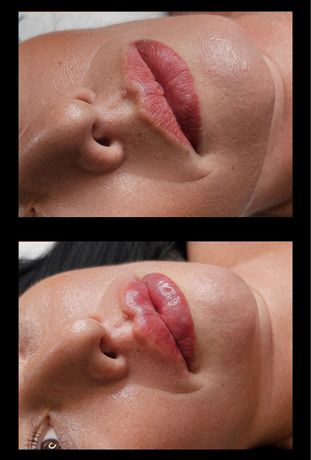Губы . Увеличение губ . Аугментация губ . Контурная пластика