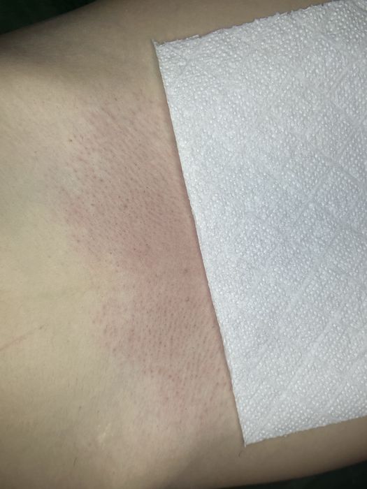 Депіляція—> Шугаринг—> Віск—> Електроепіляція Ірпінь