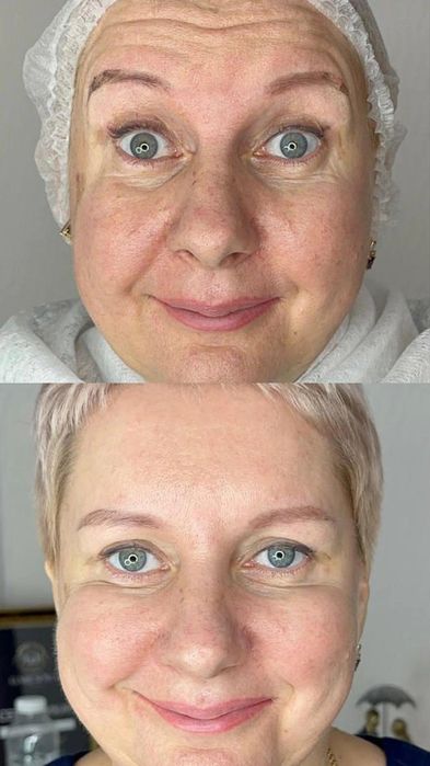 Ботокс. Коррекция морщин,всё зоны, Фулфейс.