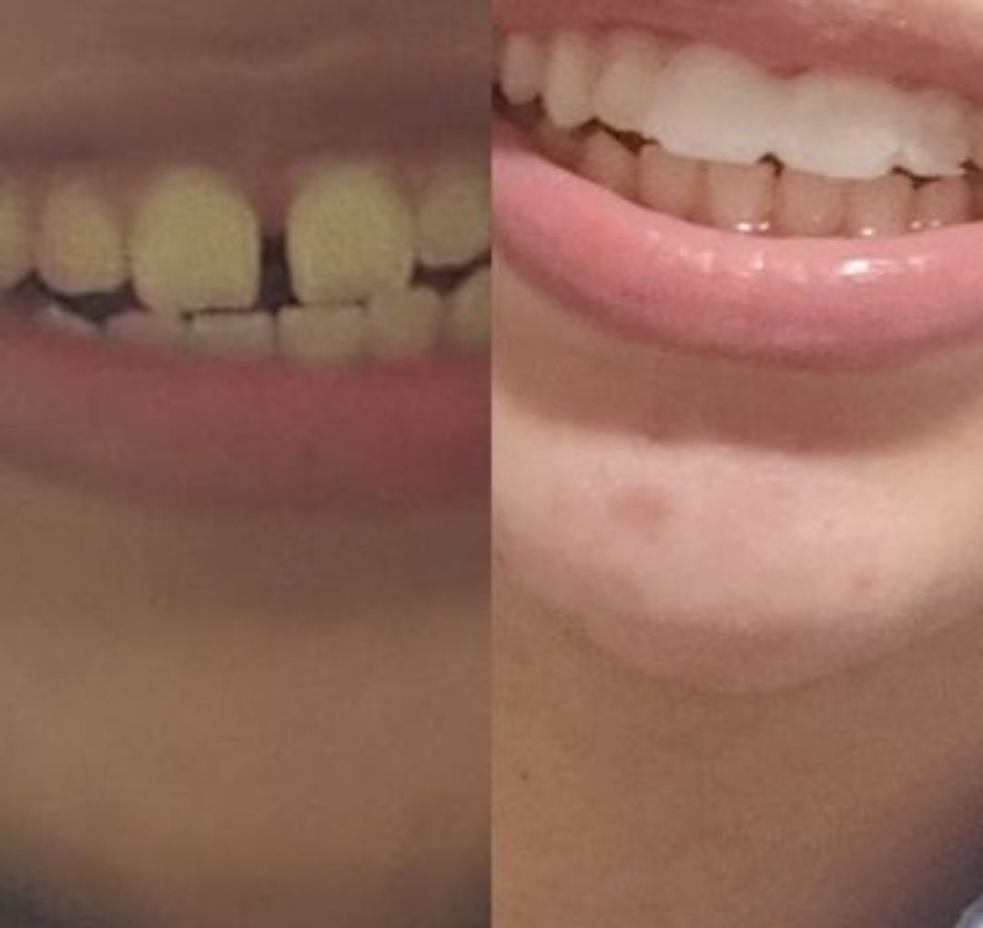 Resina Dentária! Dentaduras, Dentes em Falta e Espaços Entre os Dentes