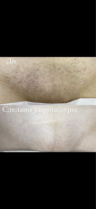 Лазерная эпиляция