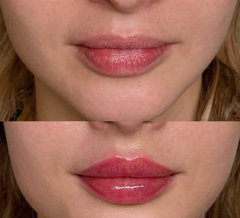 Usta 1ml od 300zł wypełniacz Premium, stymulatory, btx