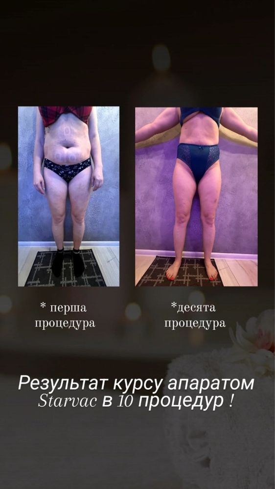 Антицеллюлитный массаж/Starvac