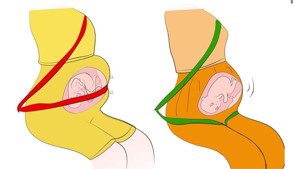 Cinto de segurança para gravidas
