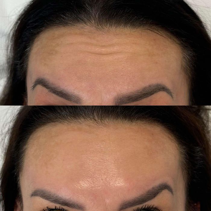 BTX EFEKT - młodszy wygląd bez skalpela !