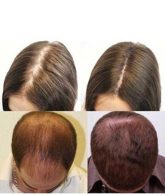 Occuba Сыворотка против выпадения волос Active Serum