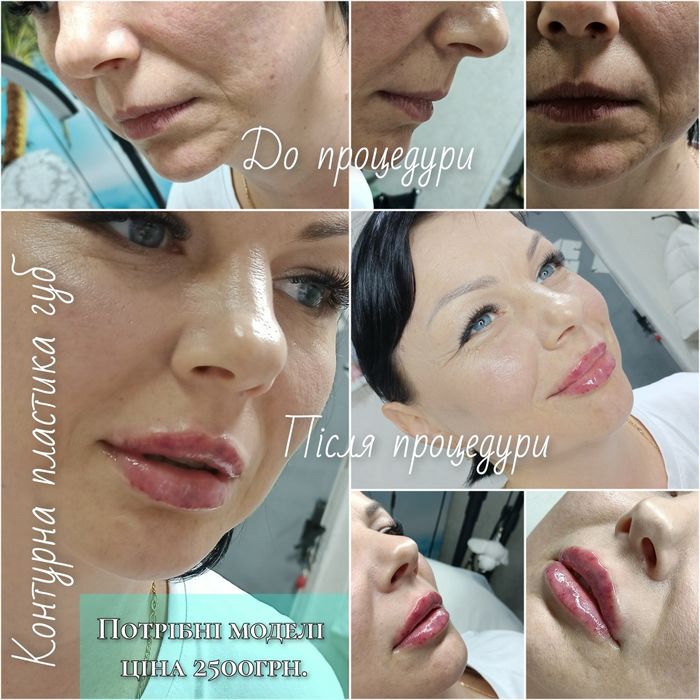 Контурна пластика губ!  2500грн.Потрібні моделі!