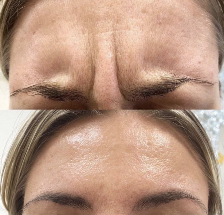 Моделі для збільшенення губ