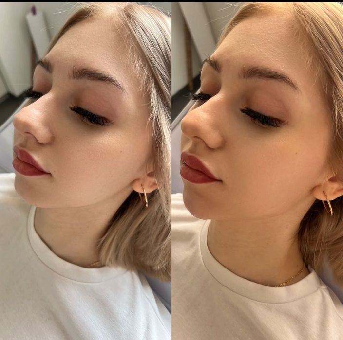 Модель на губы  ботокс Угли Джоли скули