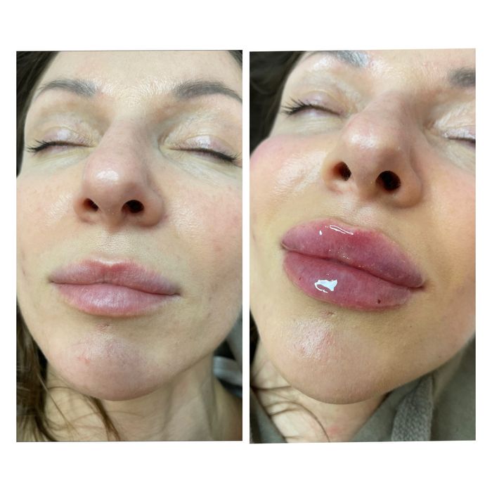 PROMOCJA  Powiększanie i Modelowanie ust/ zabiegi na twarz