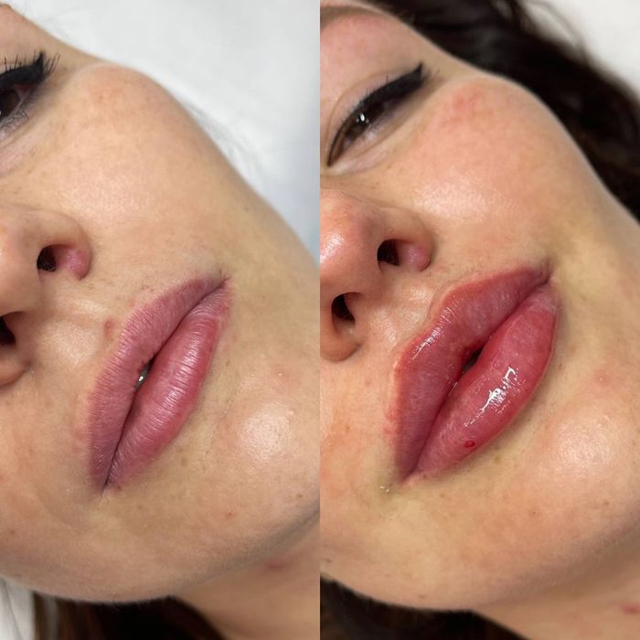 Косметолог. Акция 5 процедур по цене препарата