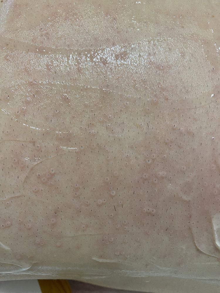 Serviço de depilação a laser