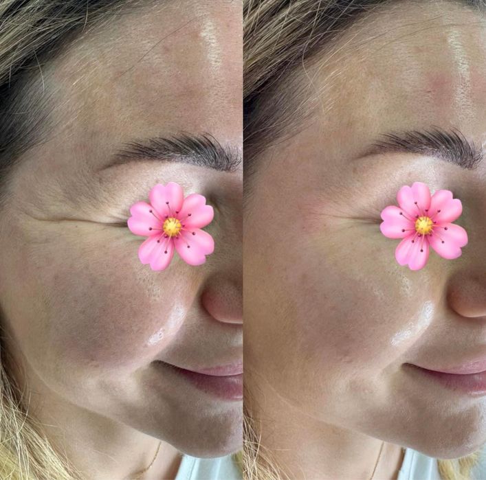 Botox Najniższa cena Botoks 150zł za 1 okolicę na zmarszczki botulina