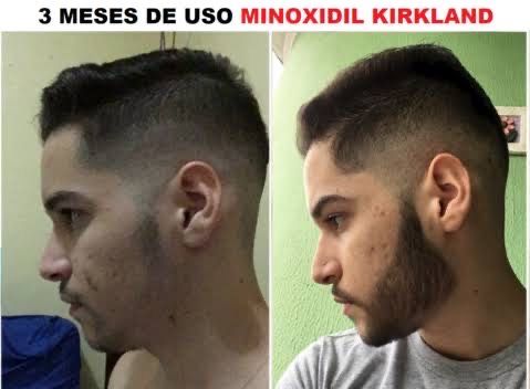 Minoxidil extra forte original Foligain 35€ com 3