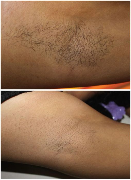 Zabieg Depilacji Laserowej / Endermologii -30% na wszystko