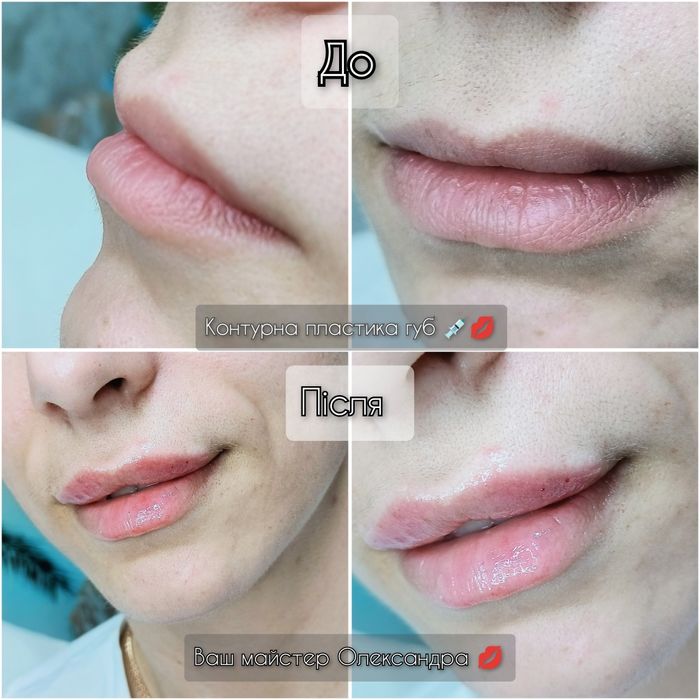 Контурна пластика губ!  2500грн.Потрібні моделі!
