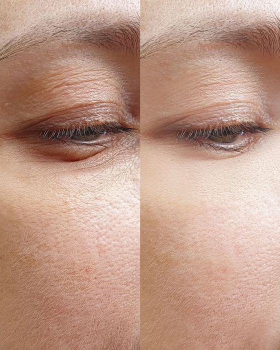 Stymulatory tkankowe pod oczy – redukcja zmarszczek i napięcie skóry