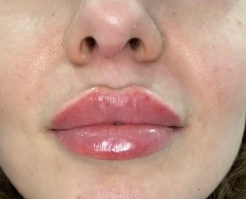 Контурна пластика губ від 3000 ботокс 1000