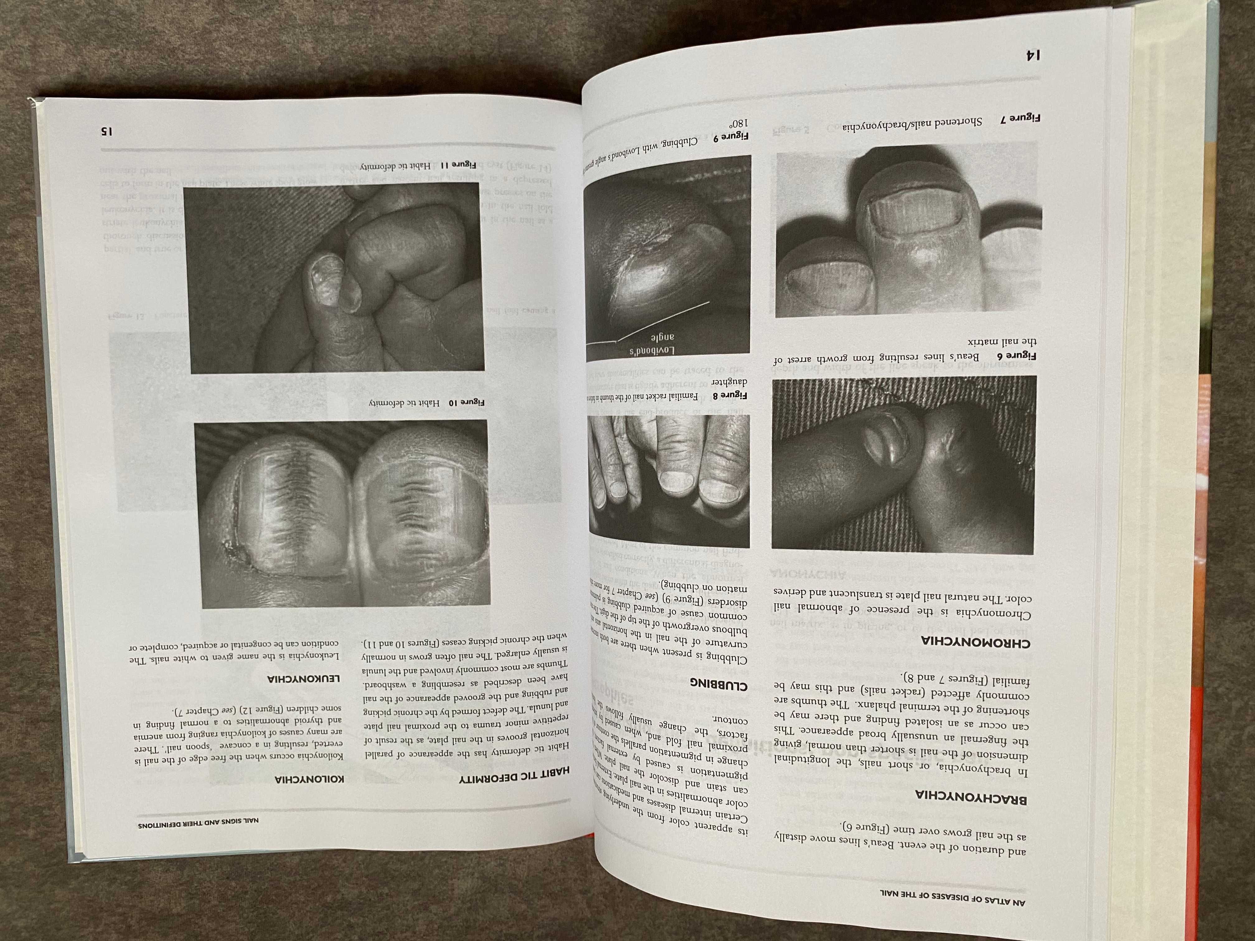 Atlas chorób paznokci "An Atlas of Diseases of The Nail"