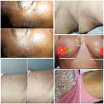 Tratamento com Jato Plasma