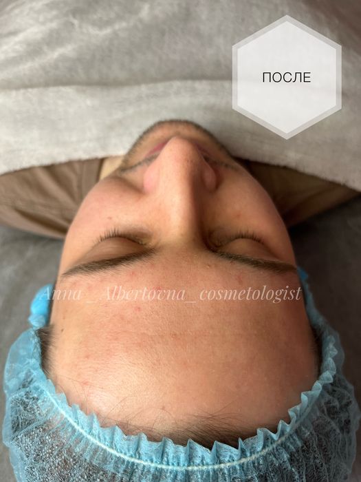 Косметолог/Ботокс Акция 1700 две зоны/Левый берег/