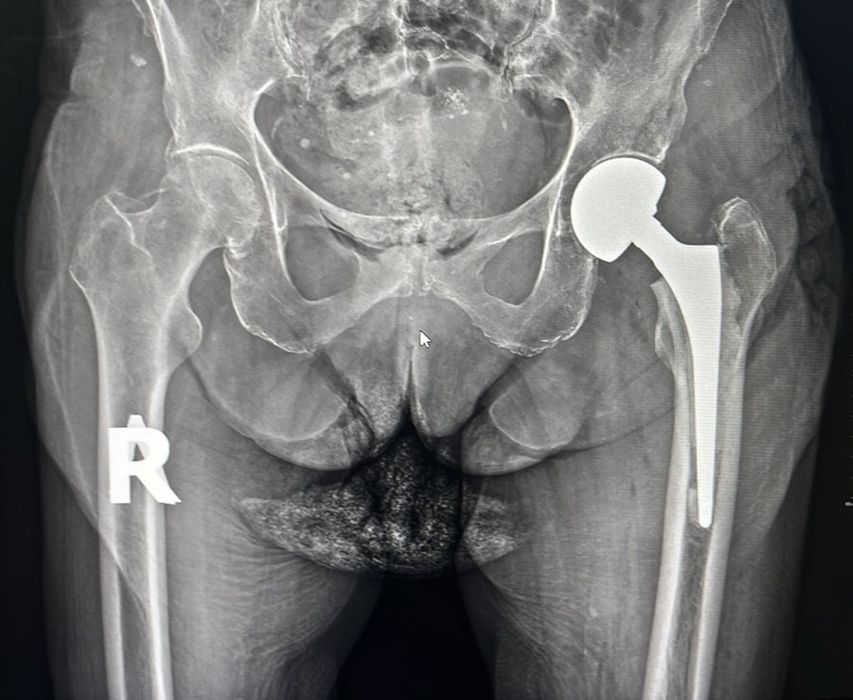 Перелом шийки стегна. Безкоштовне ендопротезування.
