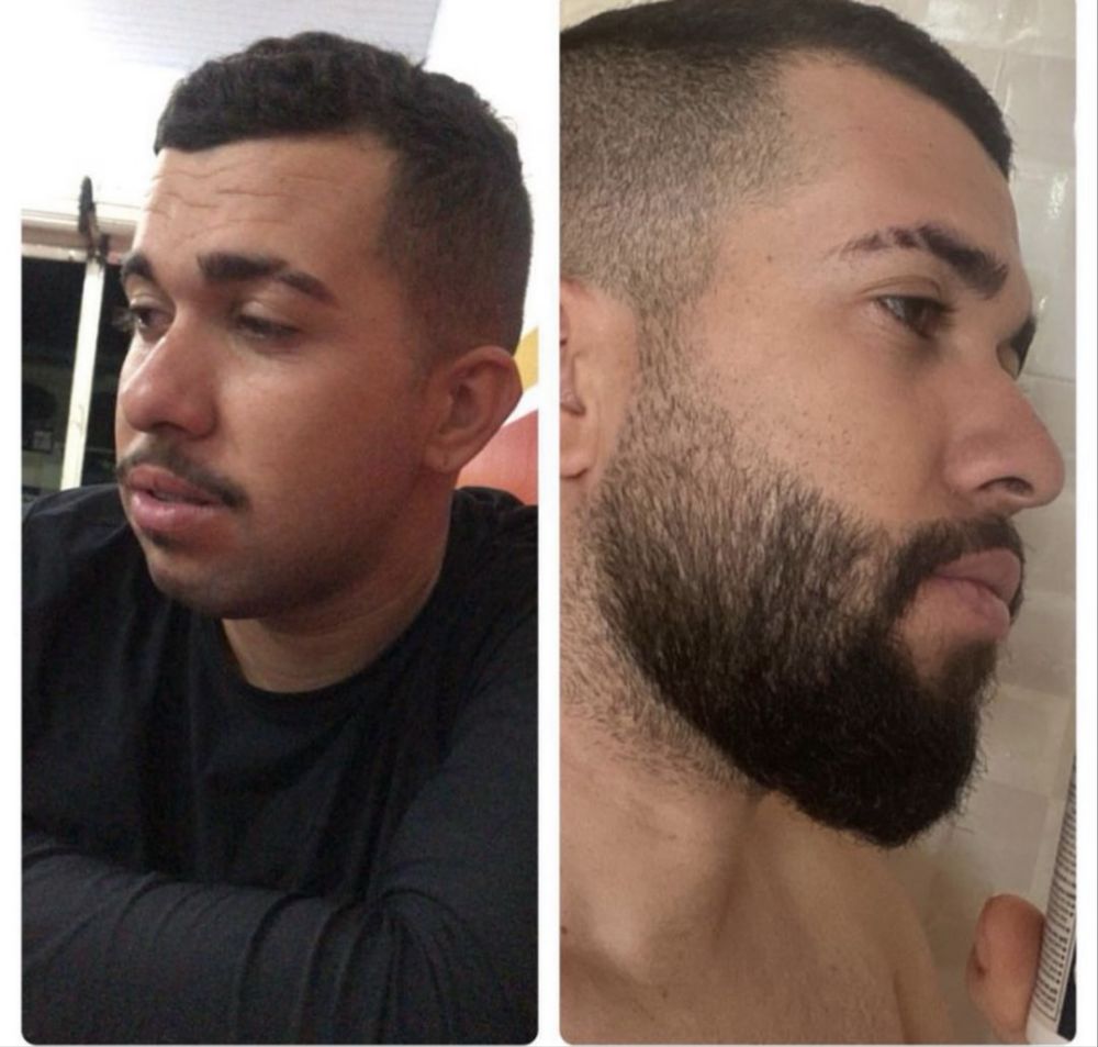 Minoxidi kirkland! Crescimento barba e cabelo