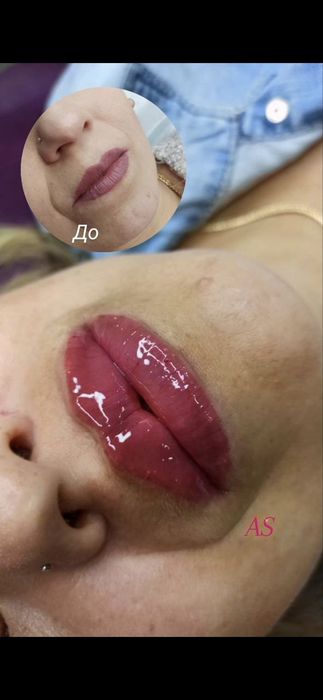 Косметолог/Ботокс/Збільшення губ/МОДЕЛІ