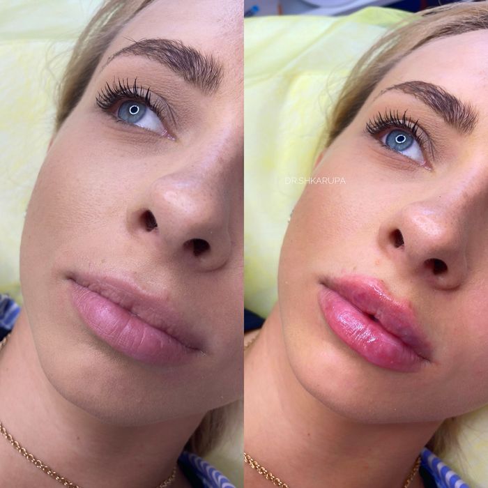 АКЦІЯ! Контурна пластика губ / збільшення губ / увеличение губ