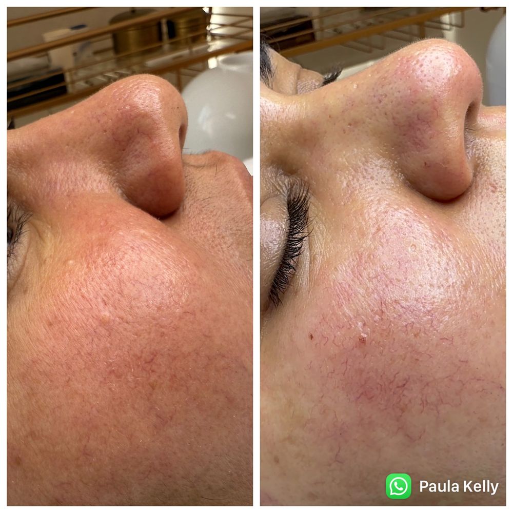 Limpeza de pele profunda