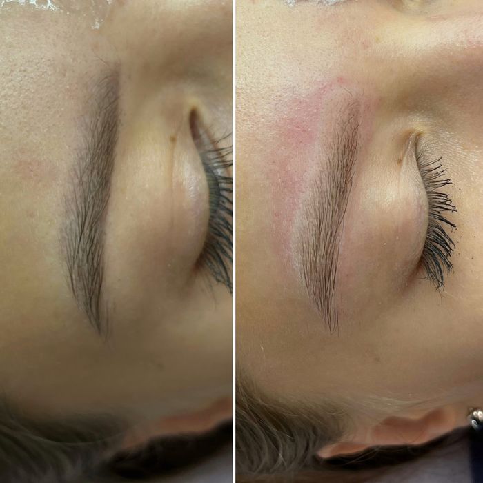 Лазерне видалення тату / татуаж / перманент