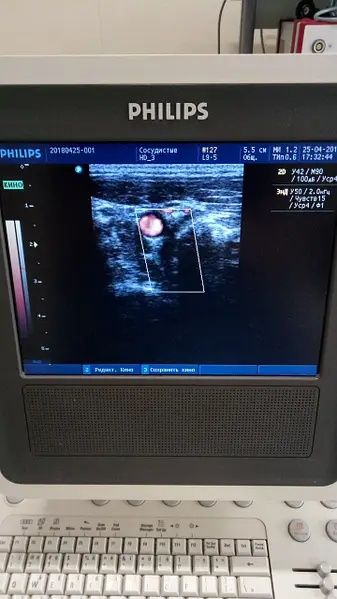 УЗИ Ультразвуковий сканер Philips HD3