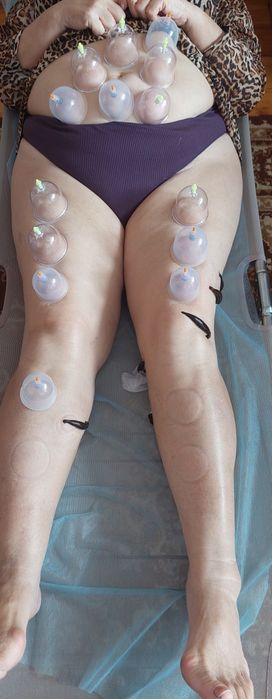 Гирудотерапия, пиявки,  хиджама