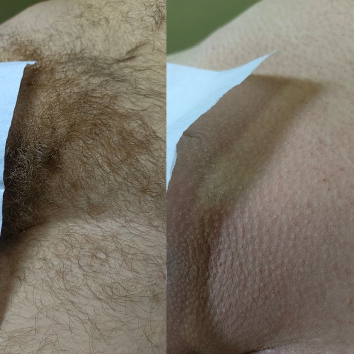 Чоловіча депіляція, видалення волосся для чоловіків на тілі та обличчі