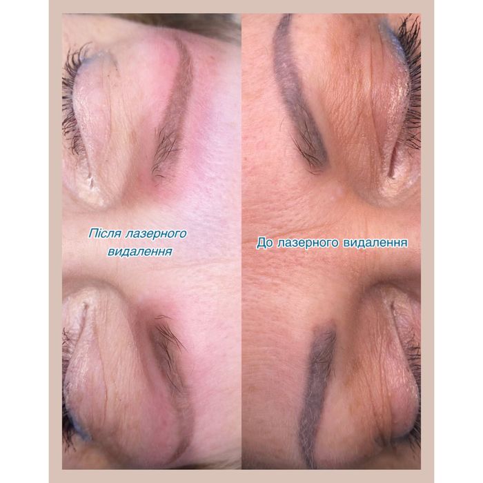 Безпечне видалення тату/татуажу, корекція шрамів