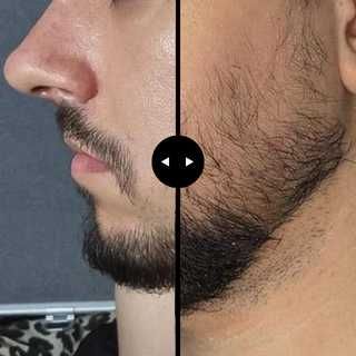 Minoxidil Kirkland - Resultados garantidos para cabelo e barba