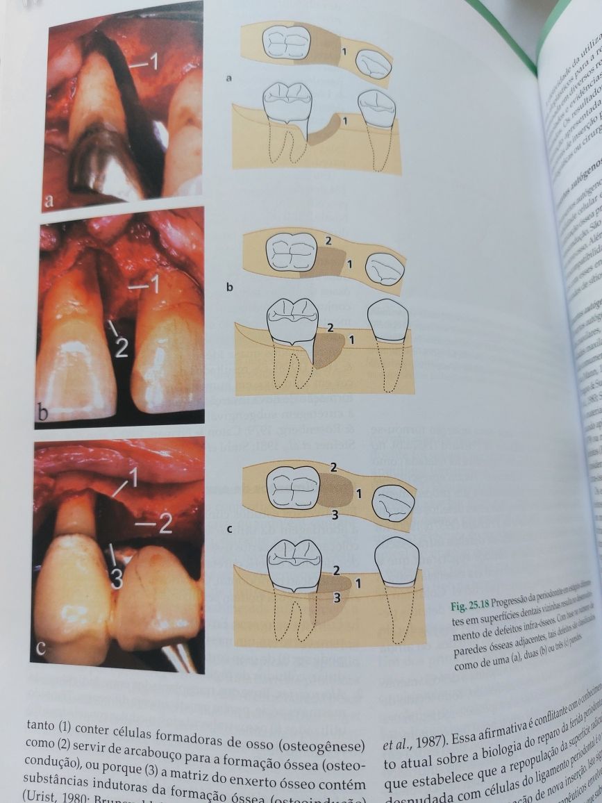 Novo!  Tratado de periodontologia Clinica e implantologia Oral
