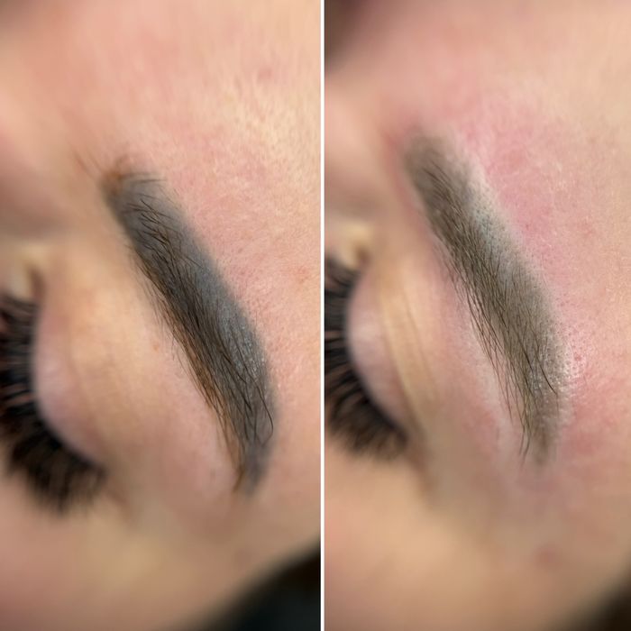 Лазерне видалення тату / татуаж / перманент