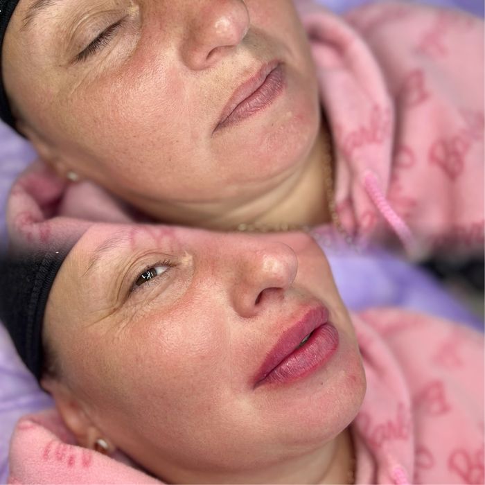 Акція. Контурна пластика губ. Запоріжжя