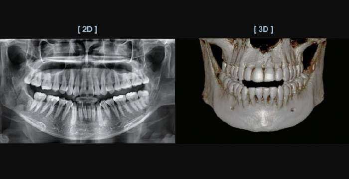 КТ зубов , панорамный снимок , рентген зуба , компьютерная томография
